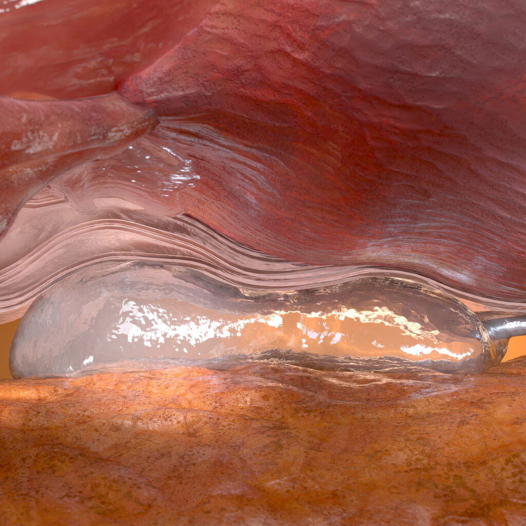 Medical visualisation of Barrigel spacer placement between the prostate and rectum