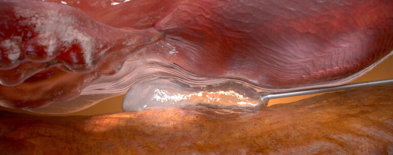 Medical visualisation of Barrigel spacer placement between the prostate and rectum
