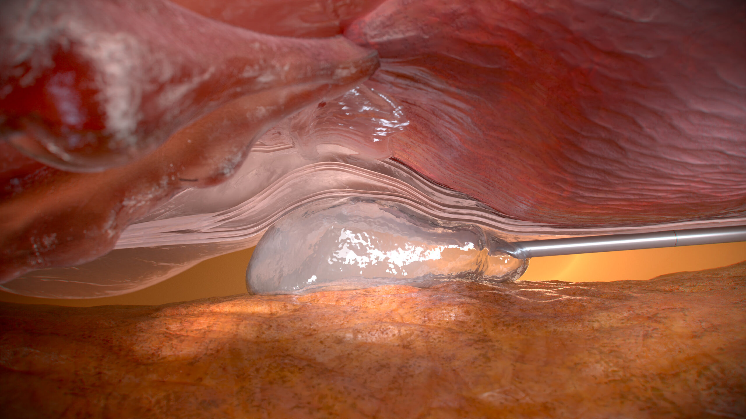 Close medical visualisation of the Barrigel spacer between the prostate and rectum