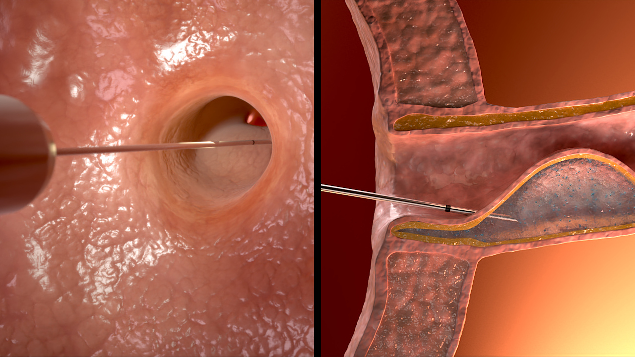 Medical visualisation of Deflux placement at a ureteral opening in the bladder