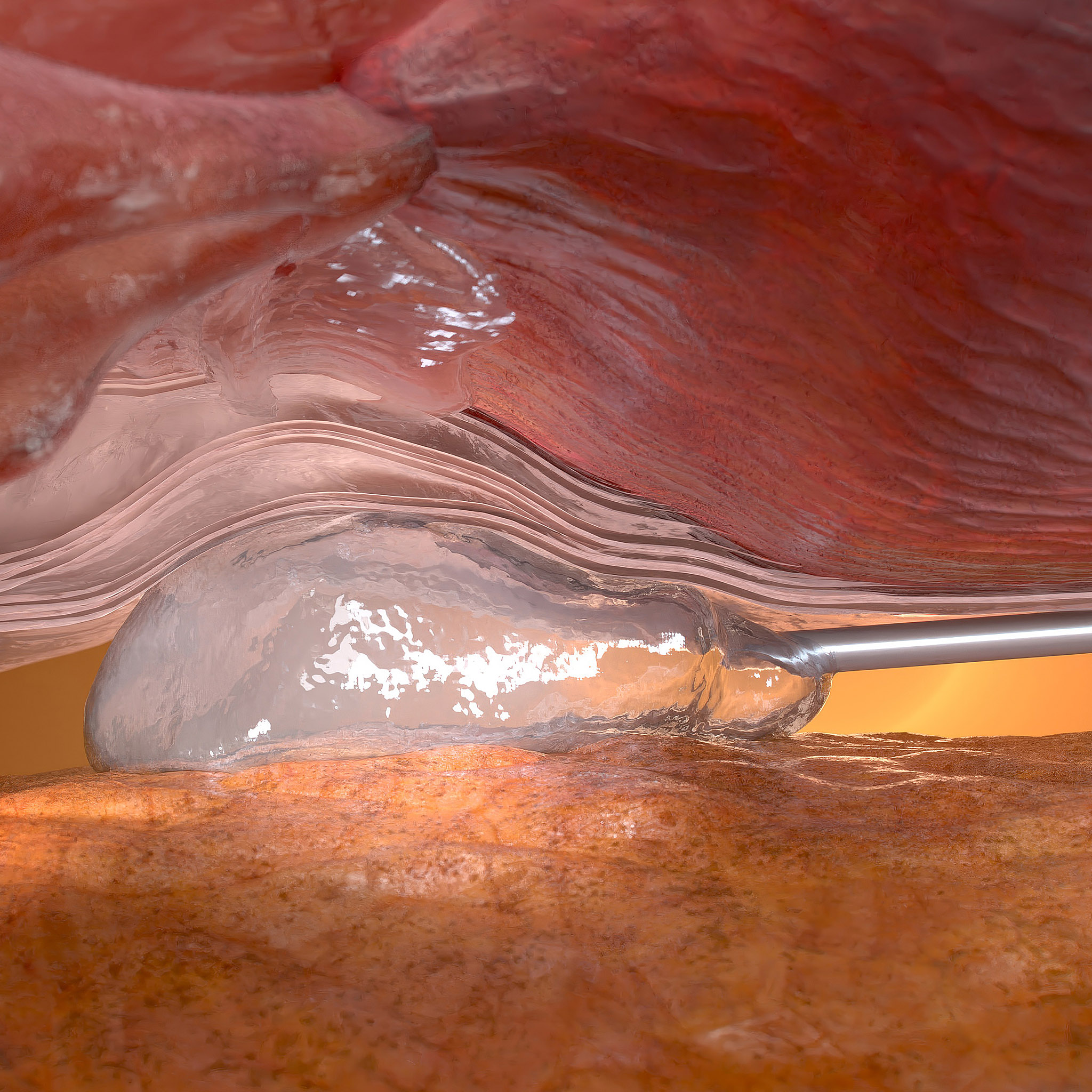 Medical visualisation of the Barrigel spacer between the prostate and rectum