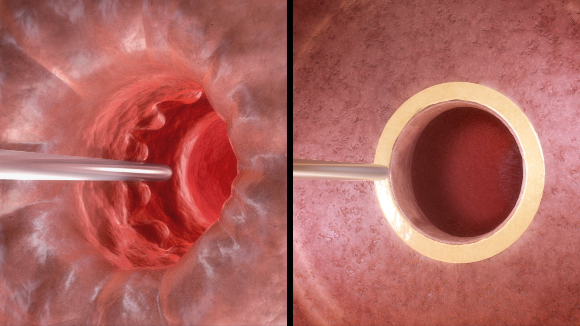 Medical visualisation of Solesta placement in the anal canal, shown in internal and cross-sectional views